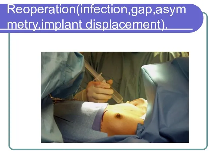 Reoperation(infection,gap,asymmetry,implant displacement).