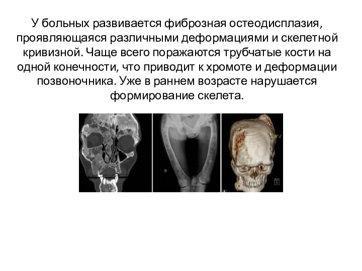 У больных развивается фиброзная остеодисплазия, проявляющаяся различными деформациями и скелетной кривизной. Чаще