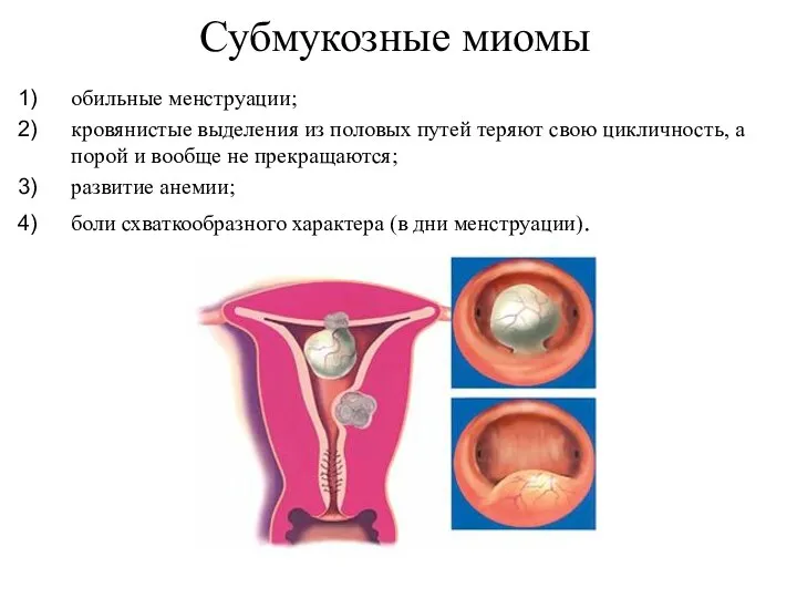 обильные менструации; кровянистые выделения из половых путей теряют свою цикличность, а порой