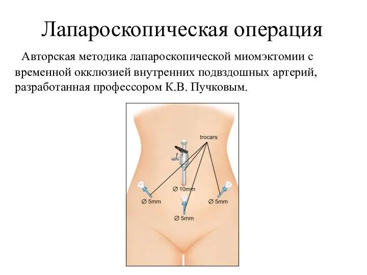 Авторская методика лапароскопической миомэктомии с временной окклюзией внутренних подвздошных артерий, разработанная профессором К.В. Пучковым. Лапароскопическая операция