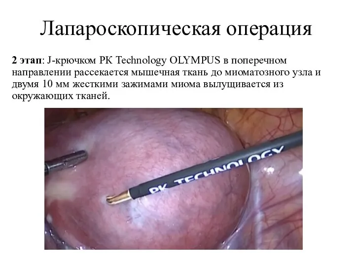 Лапароскопическая операция 2 этап: J-крючком РК Technology OLYMPUS в поперечном направлении рассекается