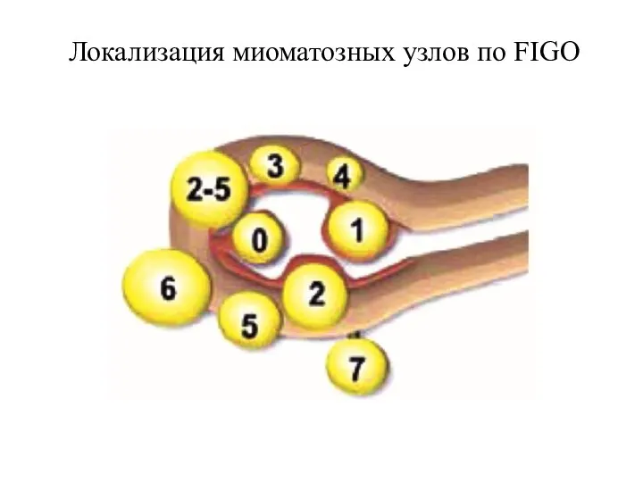 Локализация миоматозных узлов по FIGO