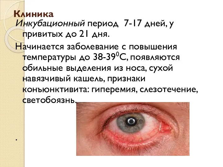 Клиника Инкубационный период 7-17 дней, у привитых до 21 дня. Начинается заболевание