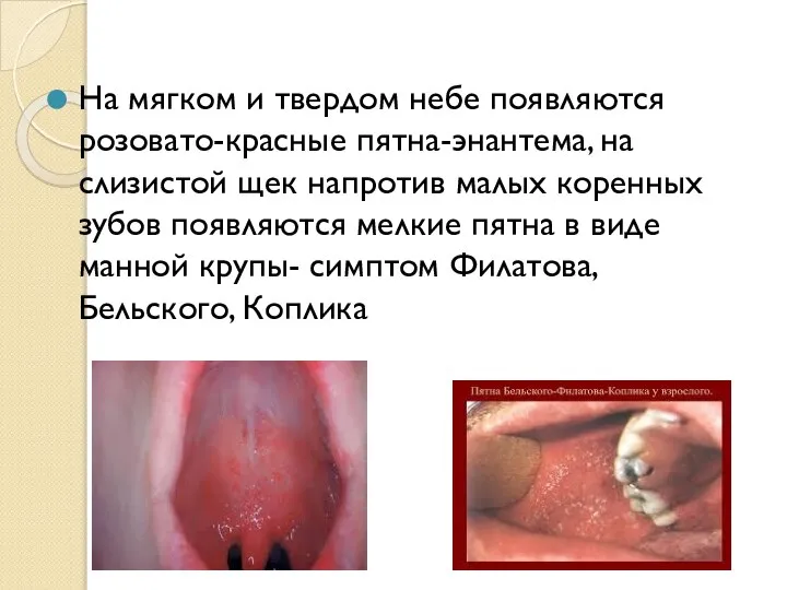 На мягком и твердом небе появляются розовато-красные пятна-энантема, на слизистой щек напротив