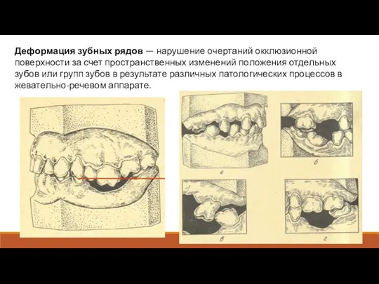 Деформация зубных рядов — нарушение очертаний окклю­зионной поверхности за счет пространственных изменений