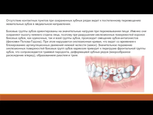 Отсутствие контактных пунктов при сохраненных зубных рядах ведет к постепенному перемещению жевательных