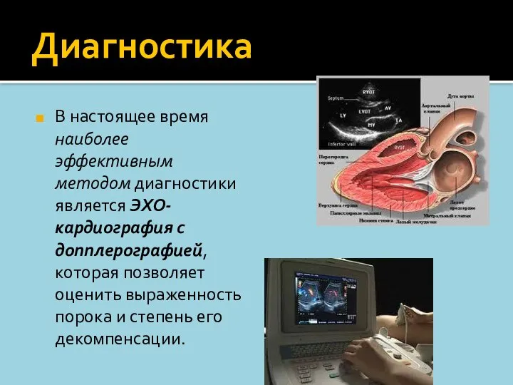 Диагностика В настоящее время наиболее эффективным методом диагностики является ЭХО-кардиография с допплерографией,