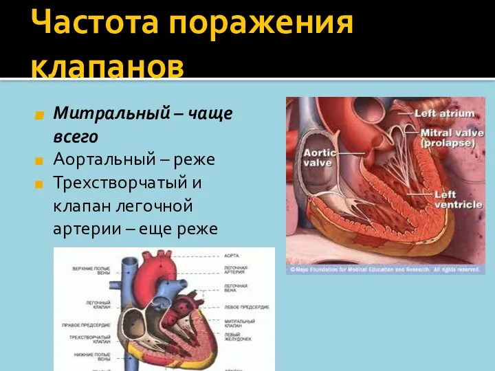 Частота поражения клапанов Митральный – чаще всего Аортальный – реже Трехстворчатый и