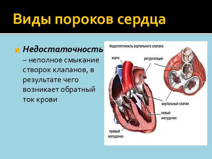 Виды пороков сердца Недостаточность – неполное смыкание створок клапанов, в результате чего возникает обратный ток крови