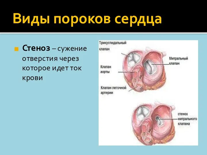 Виды пороков сердца Стеноз – сужение отверстия через которое идет ток крови