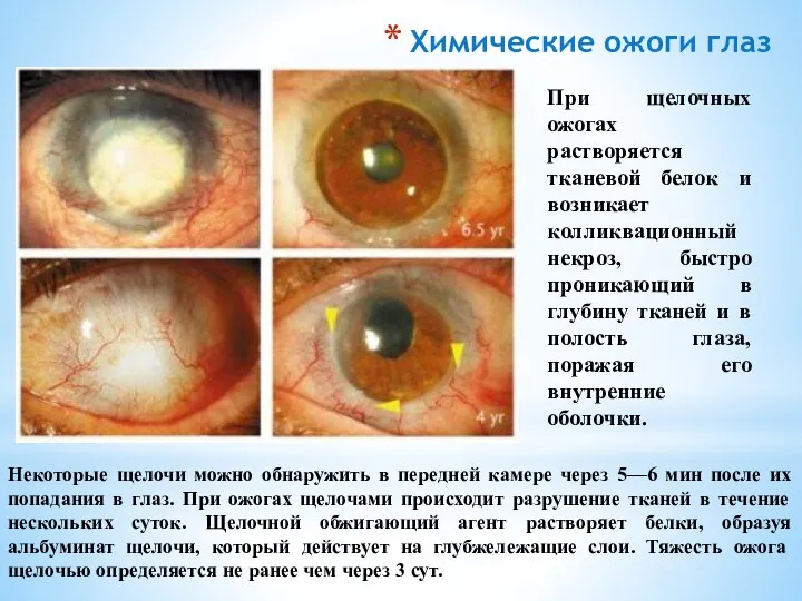 Некоторые щелочи можно обнаружить в передней камере через 5—6 мин после их
