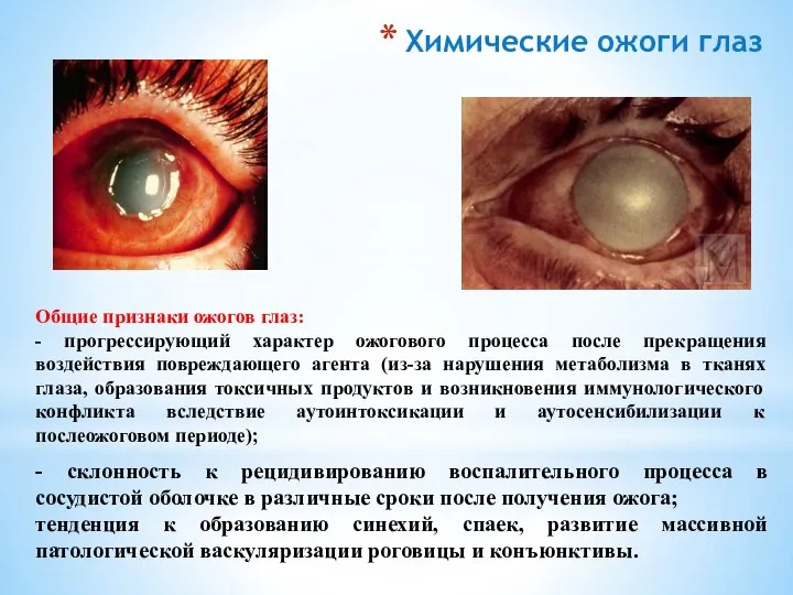 Общие признаки ожогов глаз: - прогрессирующий характер ожогового процесса после прекращения воздействия
