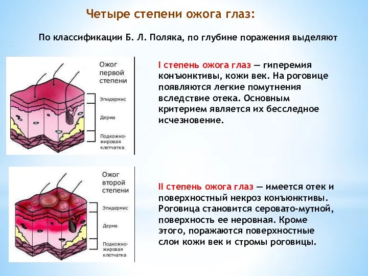 I степень ожога глаз — гиперемия конъюнктивы, кожи век. На роговице появляются