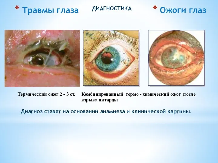 Диагноз ставят на основании анамнеза и клинической картины. ДИАГНОСТИКА Ожоги глаз Термический
