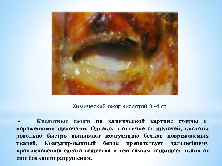 • Кислотные ожоги по клинической картине сходны с поражениями щелочами. Однако, в