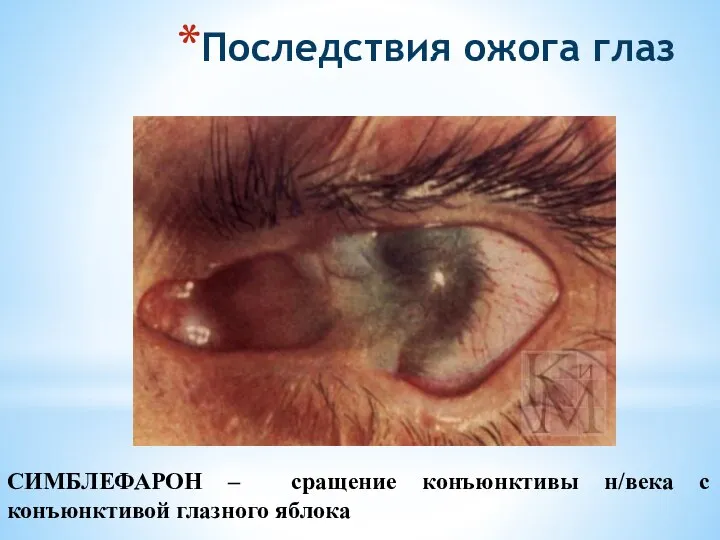 Последствия ожога глаз СИМБЛЕФАРОН – сращение конъюнктивы н/века с конъюнктивой глазного яблока