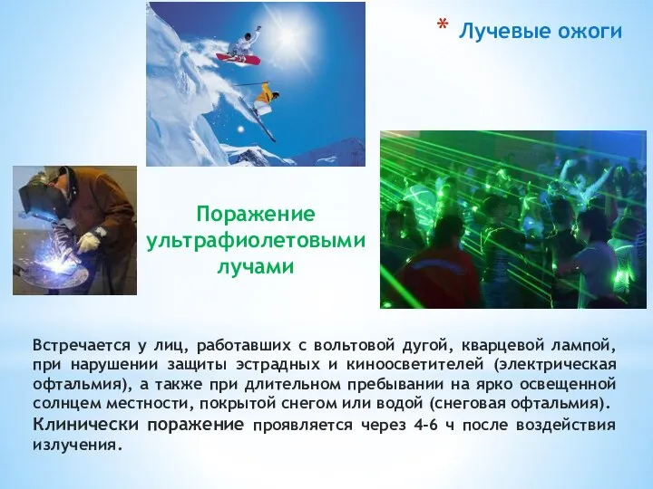 Лучевые ожоги Встречается у лиц, работавших с вольтовой дугой, кварцевой лампой, при