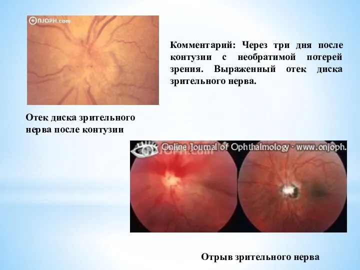Отрыв зрительного нерва Отек диска зрительного нерва после контузии Комментарий: Через три