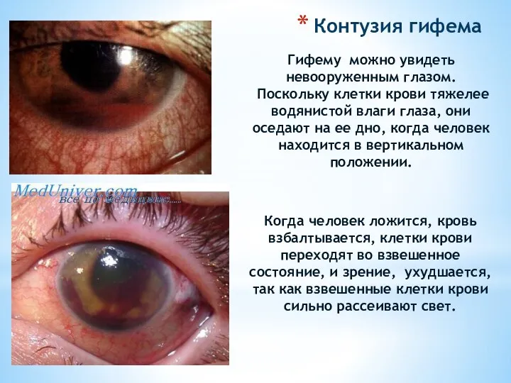 Гифему можно увидеть невооруженным глазом. Поскольку клетки крови тяжелее водянистой влаги глаза,