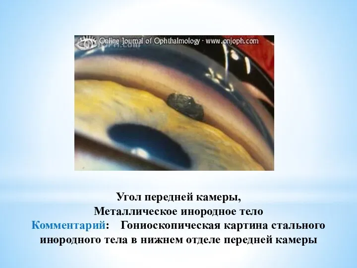 Угол передней камеры, Металлическое инородное тело Комментарий: Гониоскопическая картина стального инородного тела