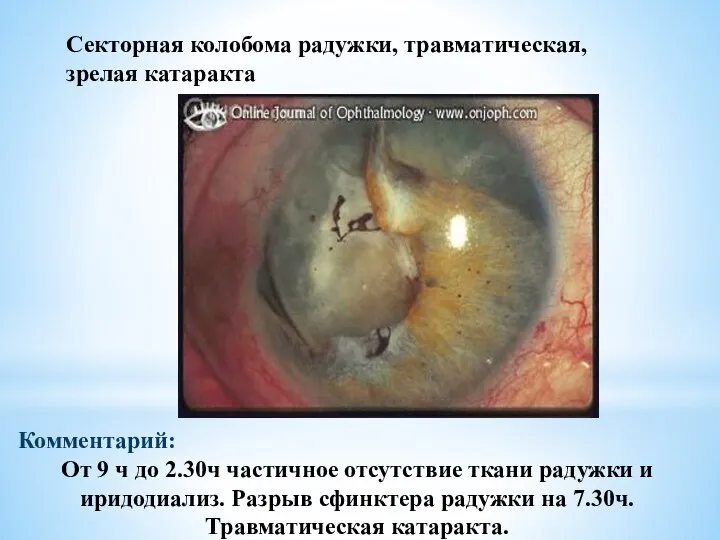 Секторная колобома радужки, травматическая, зрелая катаракта Комментарий: От 9 ч до 2.30ч