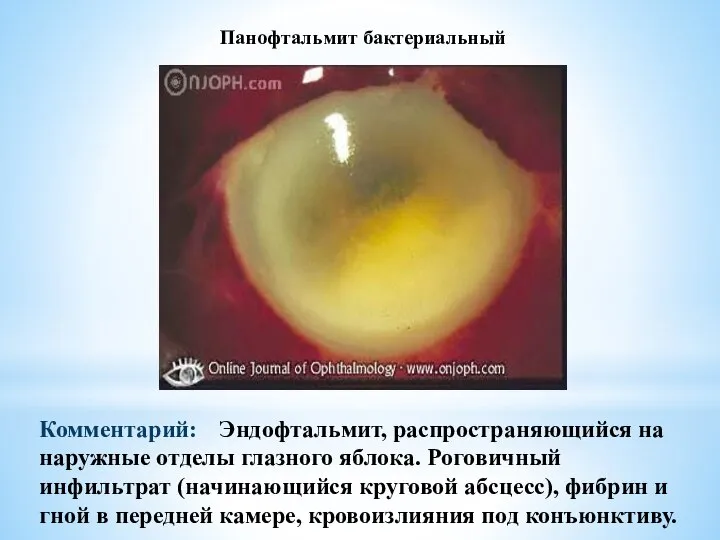 Панофтальмит бактериальный Комментарий: Эндофтальмит, распространяющийся на наружные отделы глазного яблока. Роговичный инфильтрат