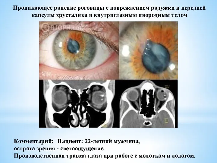 Проникающее ранение роговицы с повреждением радужки и передней капсулы хрусталика и внутриглазным
