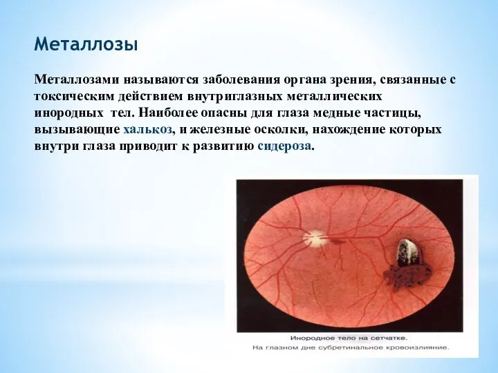 Металлозы Металлозами называются заболевания органа зрения, связанные с токсическим действием внутриглазных металлических