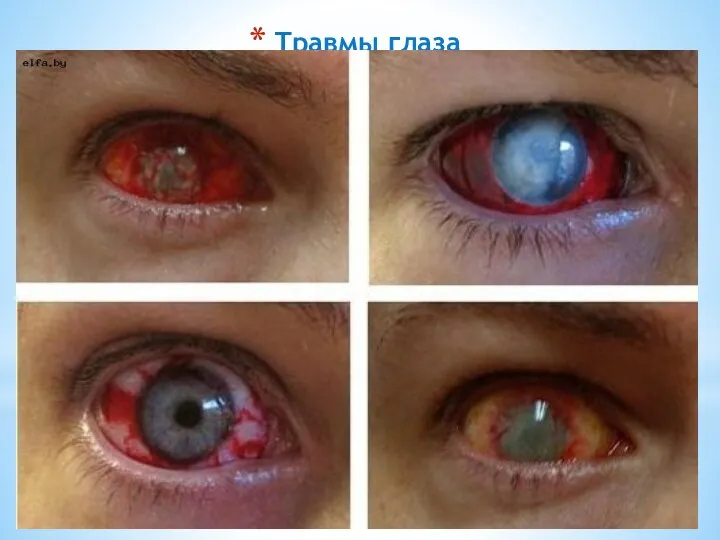 Травмы глаза