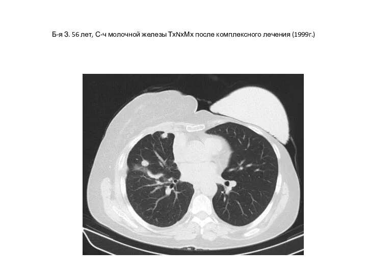 Б-я З. 56 лет, С-ч молочной железы ТхNхМх после комплексного лечения (1999г.)