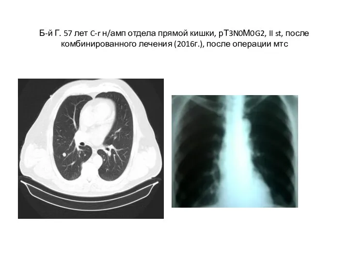 Б-й Г. 57 лет C-r н/амп отдела прямой кишки, рТ3N0М0G2, II st,