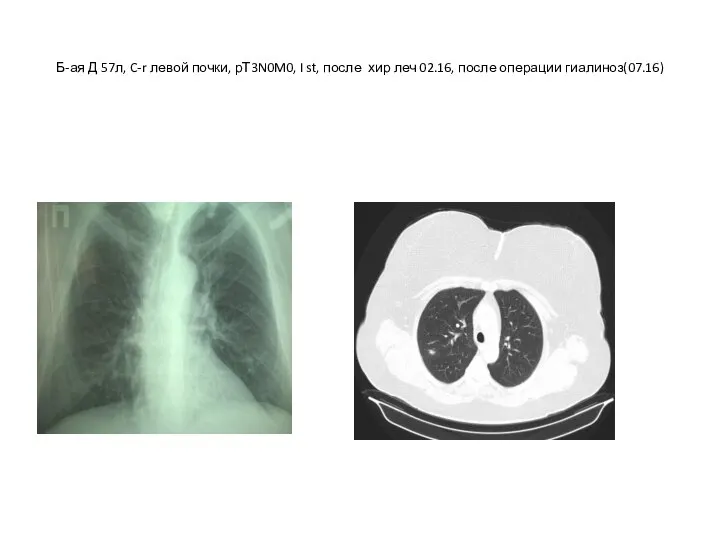 Б-ая Д 57л, C-r левой почки, рТ3N0M0, I st, после хир леч 02.16, после операции гиалиноз(07.16)