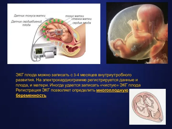 ЭКГ плода можно записать с 3-4 месяцев внутриутробного развития. На электрокардиограмме регистрируется