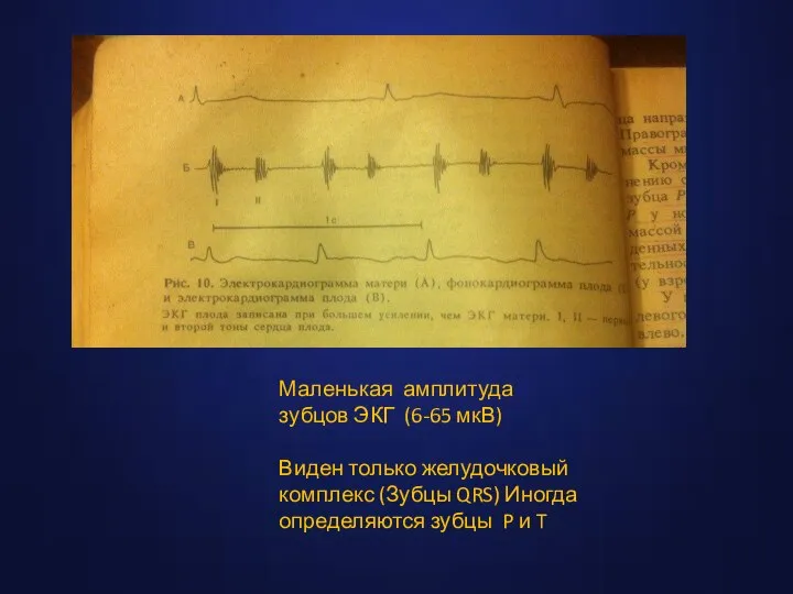 Особенности ЭКГ плода Маленькая амплитуда зубцов ЭКГ (6-65 мкВ) Виден только желудочковый