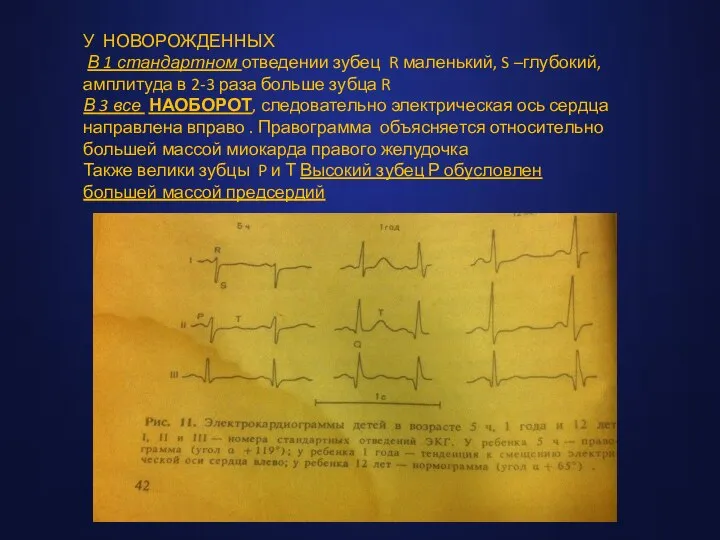 У НОВОРОЖДЕННЫХ В 1 стандартном отведении зубец R маленький, S –глубокий, амплитуда