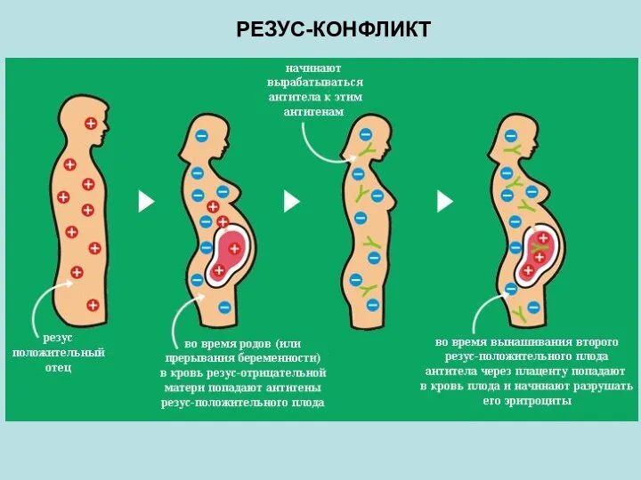 РЕЗУС-КОНФЛИКТ