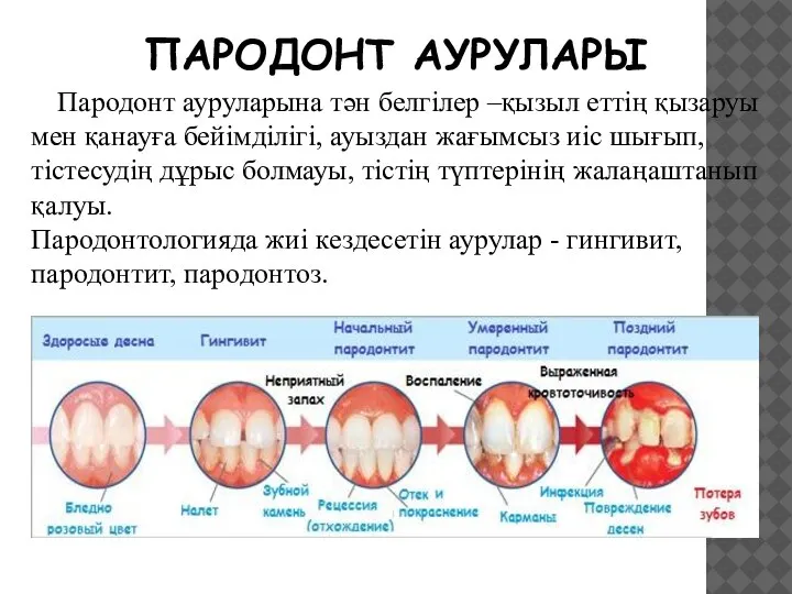 ПАРОДОНТ АУРУЛАРЫ Пародонт ауруларына тән белгілер –қызыл еттің қызаруы мен қанауға бейімділігі,