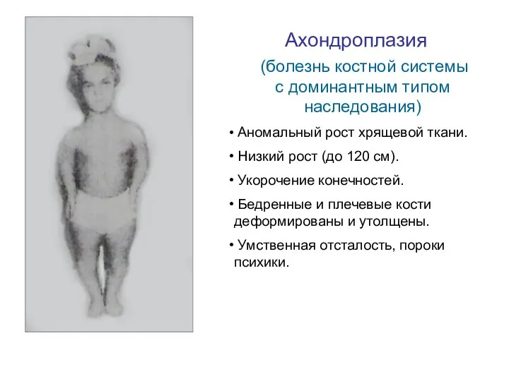 Ахондроплазия (болезнь костной системы с доминантным типом наследования) Аномальный рост хрящевой ткани.