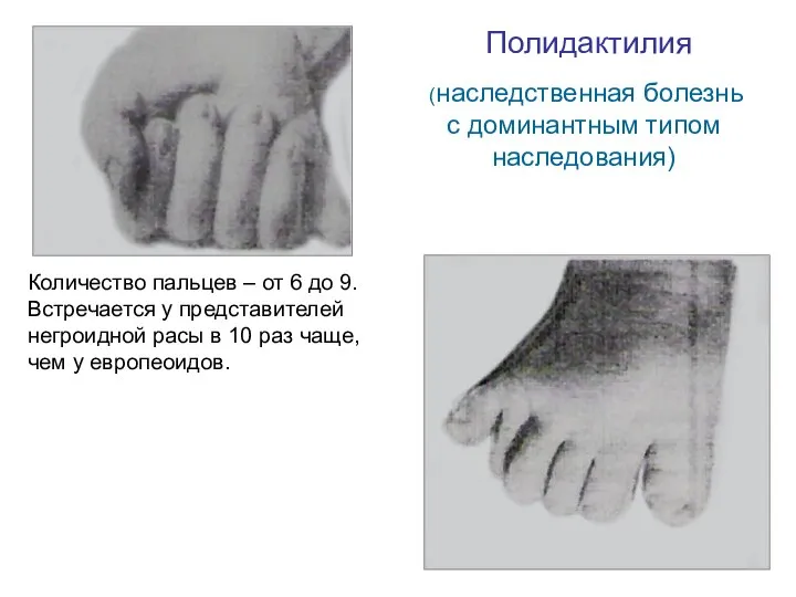 Полидактилия (наследственная болезнь с доминантным типом наследования) Количество пальцев – от 6