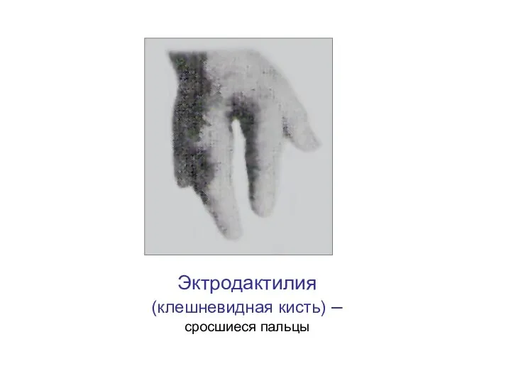 Эктродактилия (клешневидная кисть) – сросшиеся пальцы