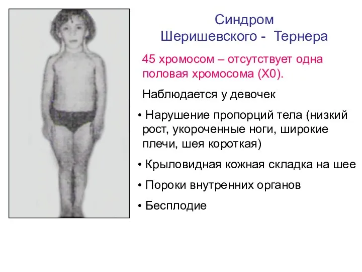 Синдром Шеришевского - Тернера 45 хромосом – отсутствует одна половая хромосома (Х0).