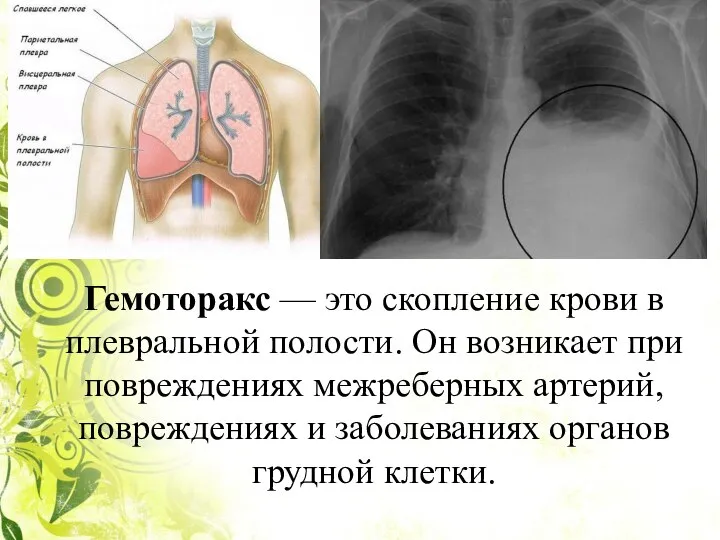 Гемоторакс — это скопление крови в плевральной полости. Он возникает при повреждениях