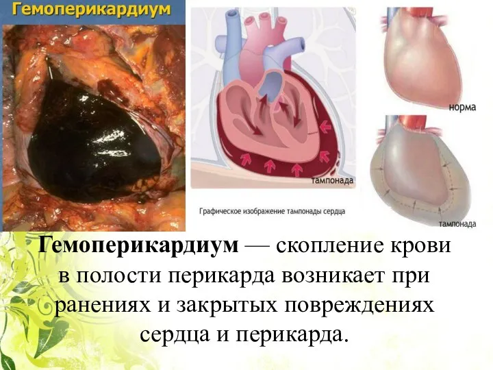 Гемоперикардиум — скопление крови в полости перикар­да возникает при ранениях и закрытых повреждениях сердца и пе­рикарда.