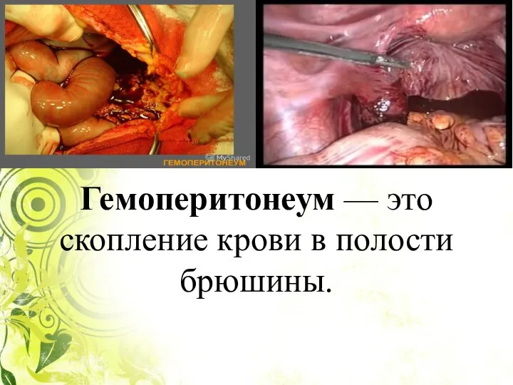 Гемоперитонеум — это скопление крови в полости брюшины.