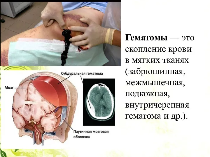 Гематомы — это скопление крови в мягких тканях (забрюшинная, межмышечная, подкожная, внутричерепная гематома и др.).