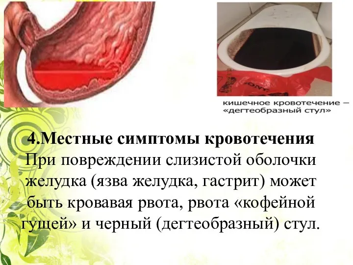 4.Местные симптомы кровотечения При повреждении слизистой оболочки желудка (язва желудка, гастрит) может