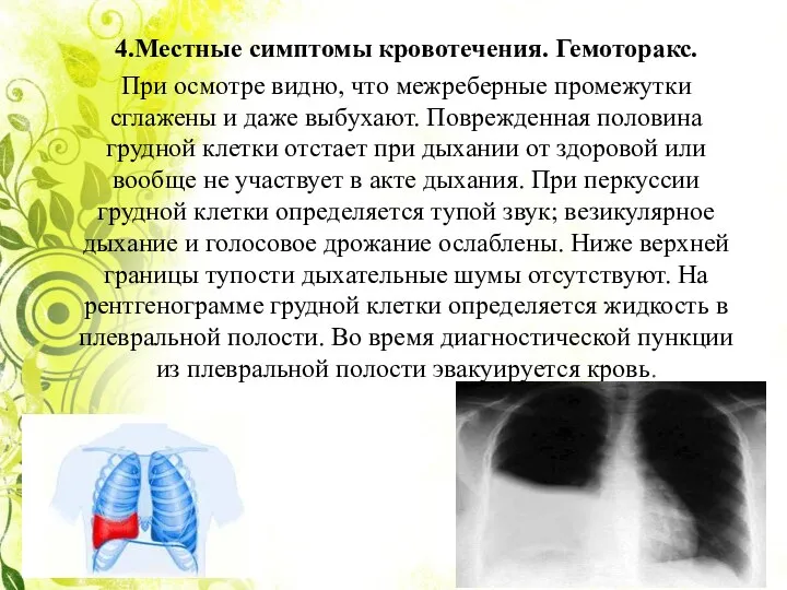 4.Местные симптомы кровотечения. Гемоторакс. При осмотре видно, что межреберные промежутки сглажены и