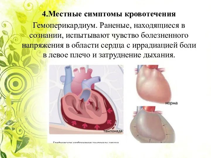 4.Местные симптомы кровотечения Гемоперикардиум. Раненые, находящиеся в сознании, испытывают чувство болезненного напряжения