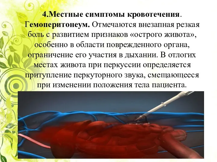 4.Местные симптомы кровотечения. Гемоперитонеум. Отмечаются внезапная резкая боль с развитием признаков «острого