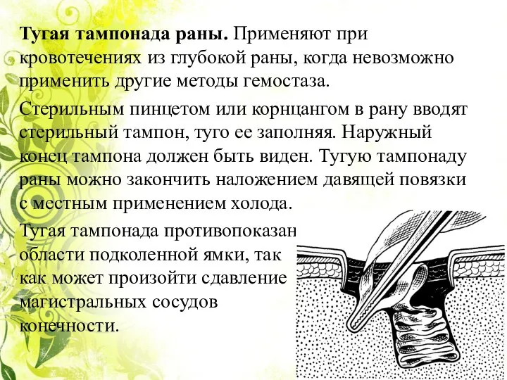 Тугая тампонада раны. Применяют при кровотечениях из глубокой раны, когда невозможно применить